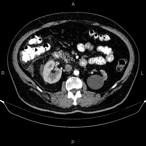 Adrenal hemorrhage (Radiopaedia 62622-70916 Axial C+ arterial phase 167).jpg