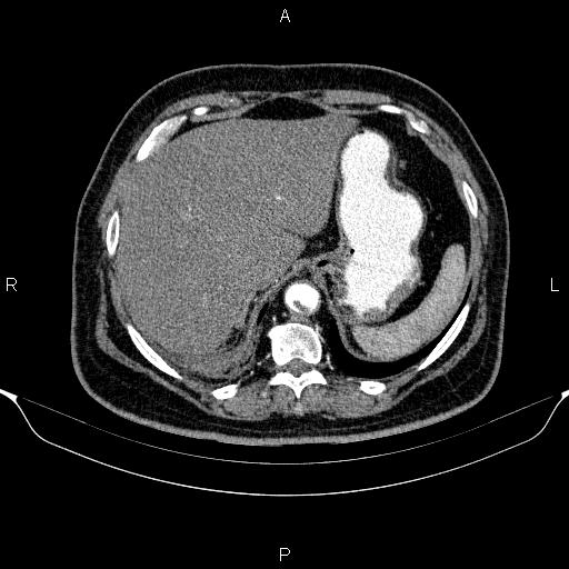 Adrenal hemorrhage (Radiopaedia 62622-70916 Axial C+ arterial phase 60).jpg