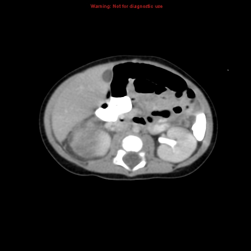 File:Adrenal hemorrhage (Radiopaedia 9390-10077 Axial C+ portal venous phase 14).jpg