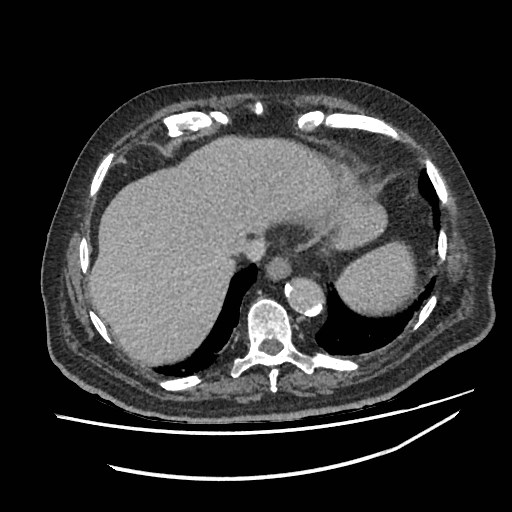Adrenal lymphoma (Radiopaedia 84145-99415 Axial C+ portal venous phase 1).jpg