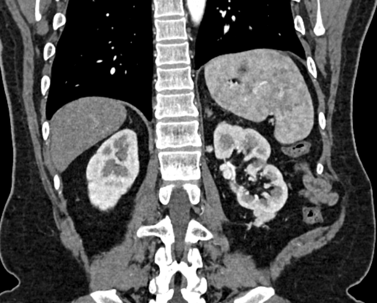 File:Adrenal metastases (Radiopaedia 73082-83791 Coronal C+ arterial phase 58).jpg