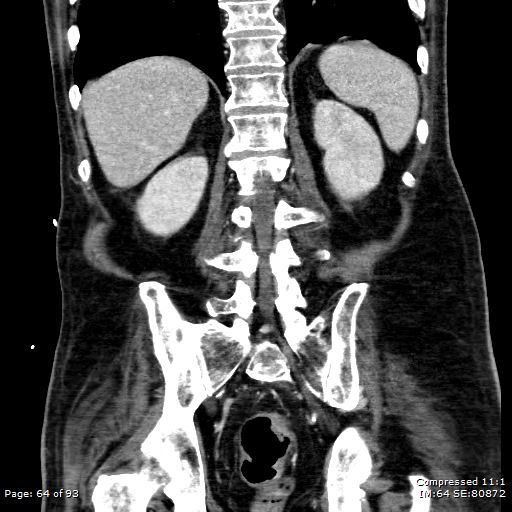 Adrenal metastasis (Radiopaedia 78425-91079 Sagittal C+ portal venous phase 51).jpg