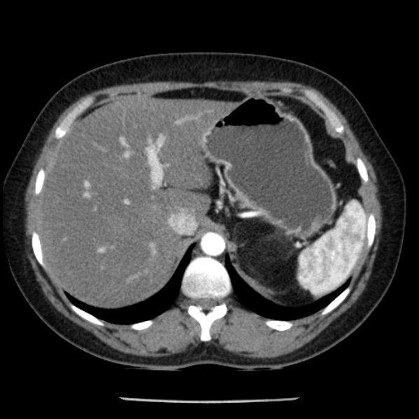 Adrenal myelolipoma (Radiopaedia 43401-46759 Axial C+ arterial phase 21).jpg