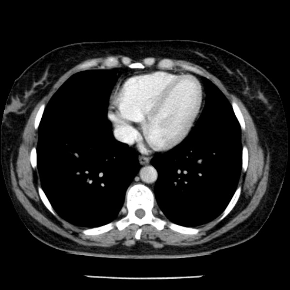 Adrenal myelolipoma (Radiopaedia 43401-46759 Axial C+ portal venous phase 1).jpg
