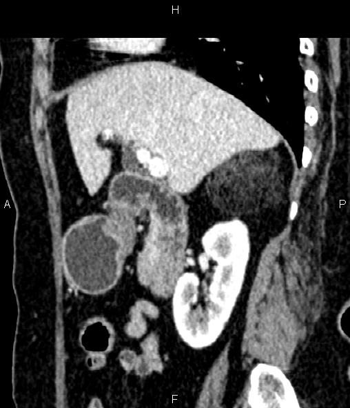Adrenal myelolipoma (Radiopaedia 82742-96986 Sagittal renal cortical phase 42).jpg