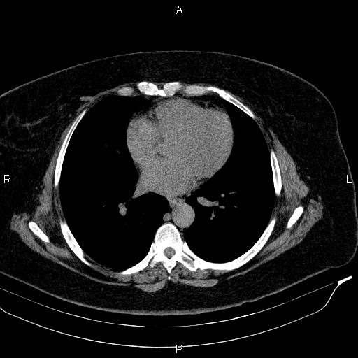 Adrenal myelolipoma (Radiopaedia 84319-99617 Axial With oral contrast 3).jpg