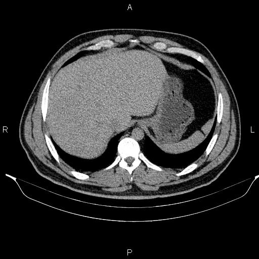 Adrenal myelolipoma (Radiopaedia 84321-99619 Axial non-contrast 19).jpg