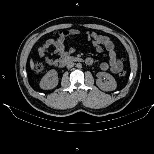Adrenal myelolipoma (Radiopaedia 84321-99619 Axial non-contrast 52).jpg