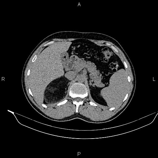 Adrenal myelolipoma (Radiopaedia 87794-104246 Axial non-contrast 33).jpg