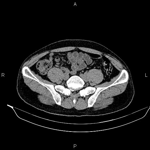 Adrenal myelolipoma (Radiopaedia 87794-104246 Axial non-contrast 76).jpg