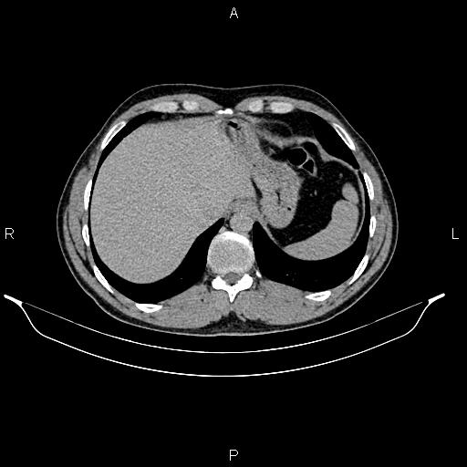 Adrenal myelolipoma (Radiopaedia 87794-104246 Axial renal excretory phase 15).jpg