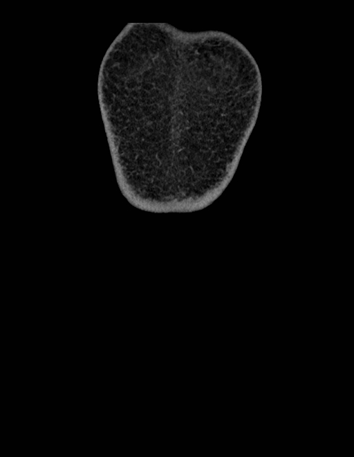 Adrenal myelolipoma - bilateral (Radiopaedia 74805-85810 Coronal C+ portal venous phase 269).jpg