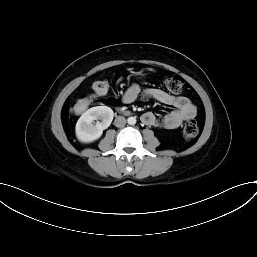 Adrenocortical carcinoma (Radiopaedia 87281-103569 Axial C+ portal venous phase 46).jpg