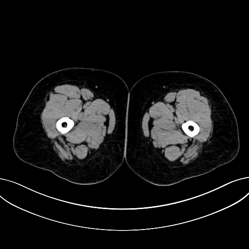 Adrenocortical carcinoma (Radiopaedia 87281-103569 Axial non-contrast 104).jpg