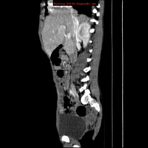 File:Adrenocortical carcinoma (Radiopaedia 9449-10131 Sagittal C+ portal venous phase 3).jpg