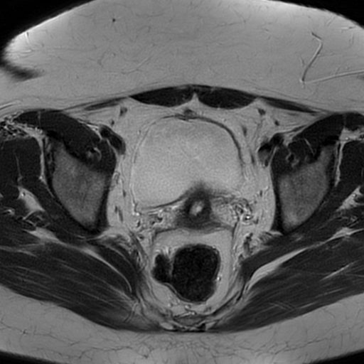 File:Adult granulosa cell tumor of the ovary (Radiopaedia 64991-73953 Axial T2 15).jpg