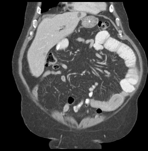 Adult ileal intussusception with secondary obstruction (Radiopaedia 30395-31051 Coronal C+ portal venous phase 19).jpg