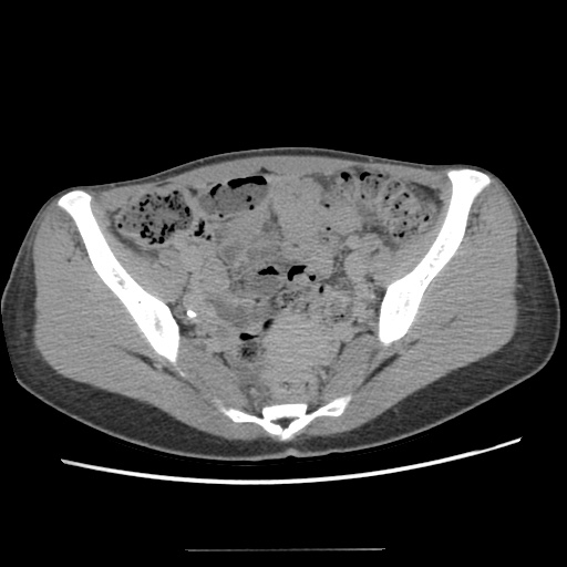 File:Adult polycystic kidney disease (Radiopaedia 48845-53876 Axial renal excretory phase 78).jpg