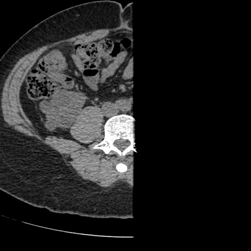 Adult polycystic kidney disease (Radiopaedia 59075-66368 Axial non-contrast 56).jpg