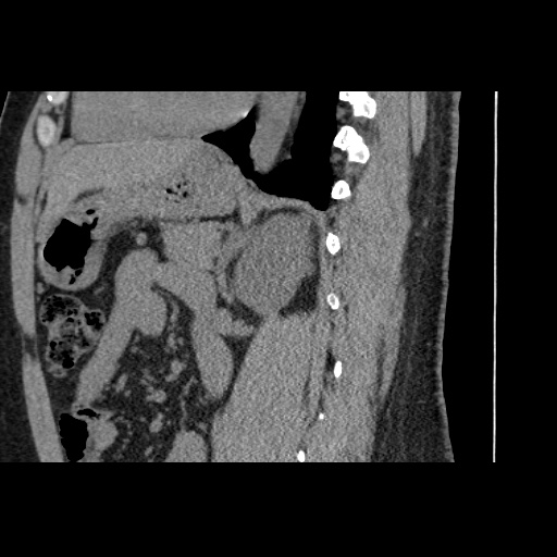 Adult polycystic kidney disease (Radiopaedia 59075-66368 Sagittal non-contrast 54).jpg