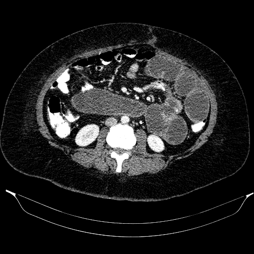Afferent loop syndrome - secondary to incarcerated trocar site hernia (Radiopaedia 82959-97305 Axial C+ portal venous phase 119).jpg
