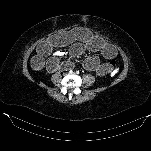 File:Afferent loop syndrome - secondary to incarcerated trocar site hernia (Radiopaedia 82959-97305 Axial C+ portal venous phase 152).jpg