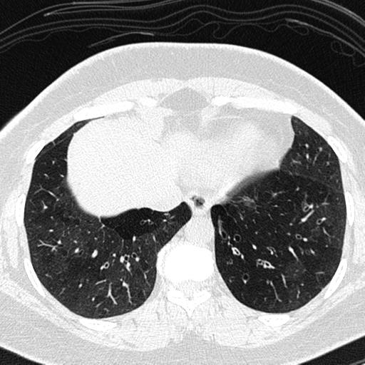 File:Air trapping in small airway disease (Radiopaedia 61685-69694 Axial lung window 143).jpg