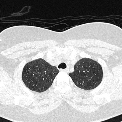 Air trapping in small airway disease (Radiopaedia 61685-69694 Axial lung window 29).jpg