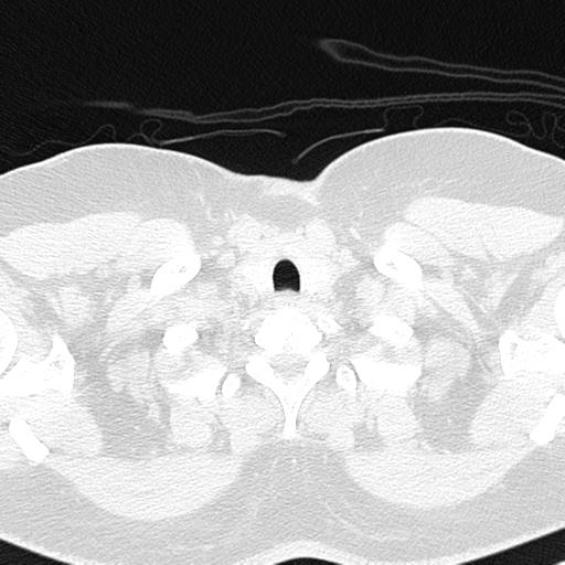 File:Air trapping in small airway disease (Radiopaedia 61685-69694 Axial lung window 6).jpg