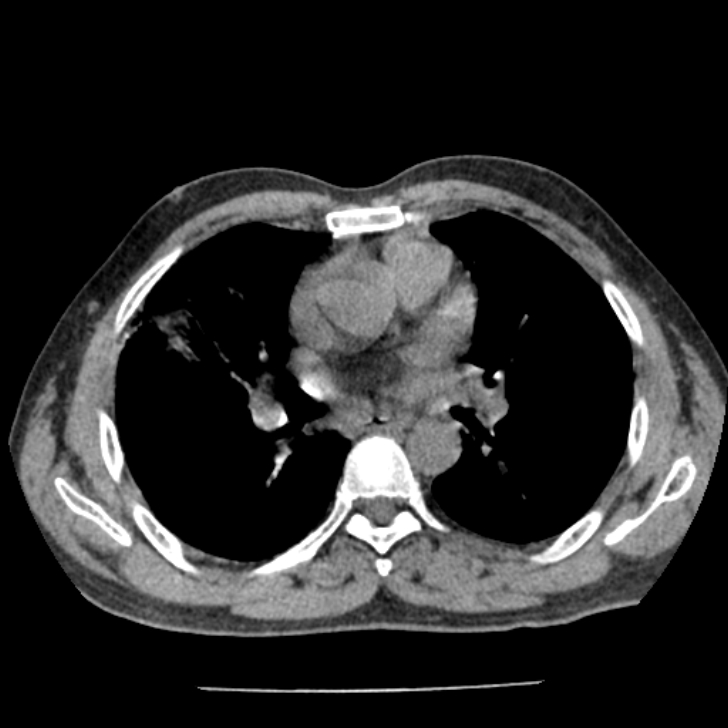 Airway foreign body in adult (Radiopaedia 85907-101779 Axial liver window 87).jpg