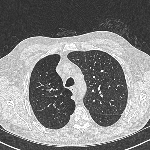 Allergic bronchopulmonary aspergillosis (Radiopaedia 44760-48571 Axial lung window 18).png