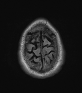 File:Alzheimer's disease- with Gerstmann syndrome and dressing apraxia (Radiopaedia 54882-61150 Axial FLAIR 26).png