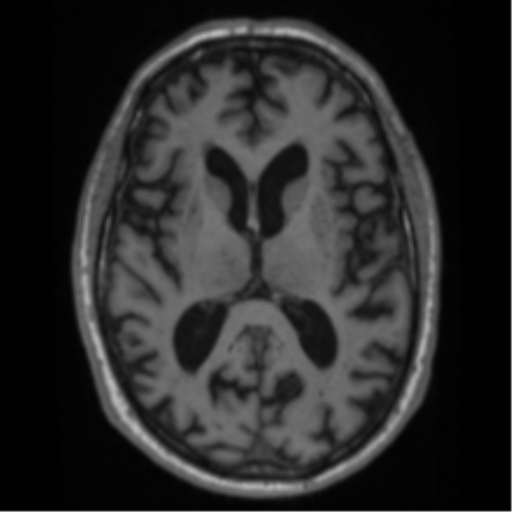 Alzheimer's disease- with Gerstmann syndrome and dressing apraxia (Radiopaedia 54882-61150 Axial T1 40).png