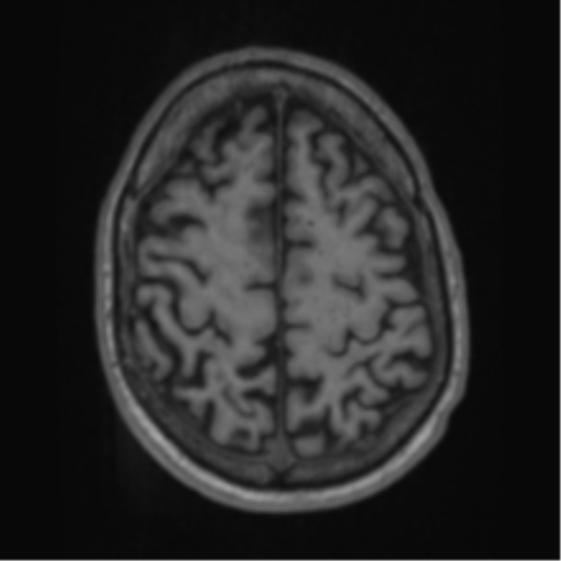 Alzheimer's disease- with apraxia (Radiopaedia 54763-61011 Axial T1 58).png