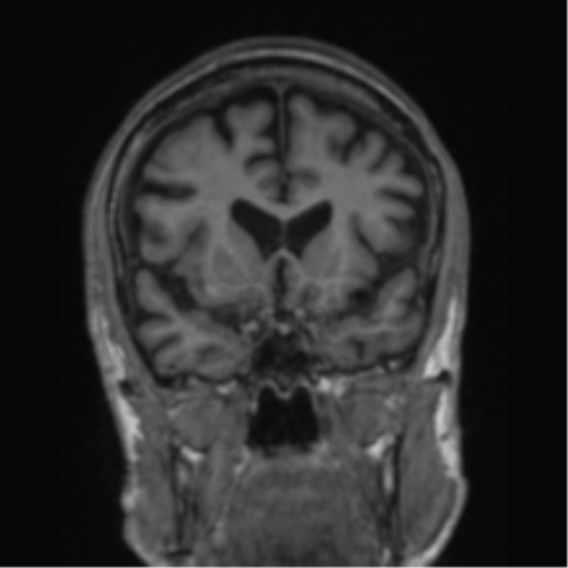 File:Alzheimer's disease- with apraxia (Radiopaedia 54763-61011 Coronal T1 62).png