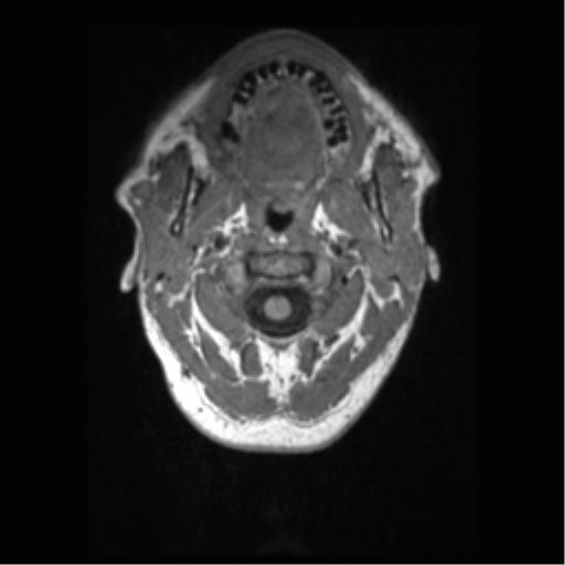 Alzheimer disease - probable (Radiopaedia 35334-36837 Axial T1 1).png