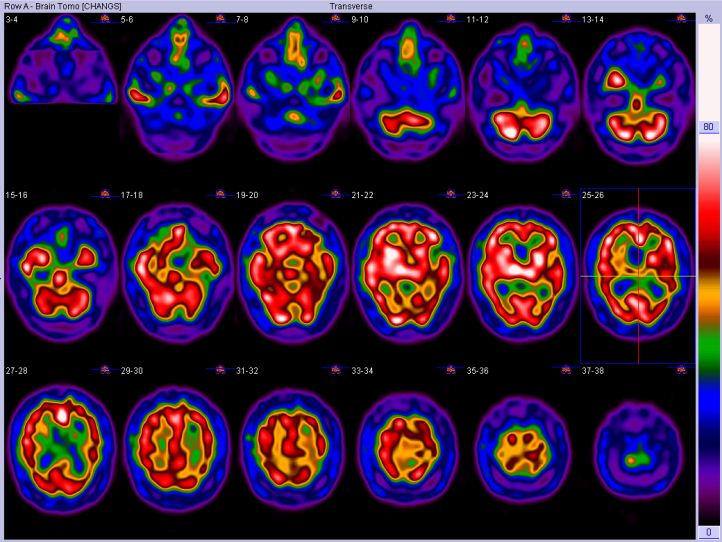 File:Alzheimer disease - probable (Radiopaedia 35334-36838 Axial 1).JPG