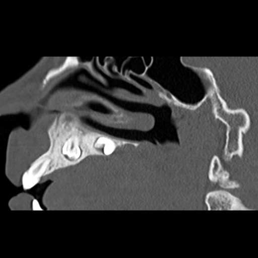 File:Ameloblastic fibro-odontoma (Radiopaedia 18843-18780 bone window 4).jpg