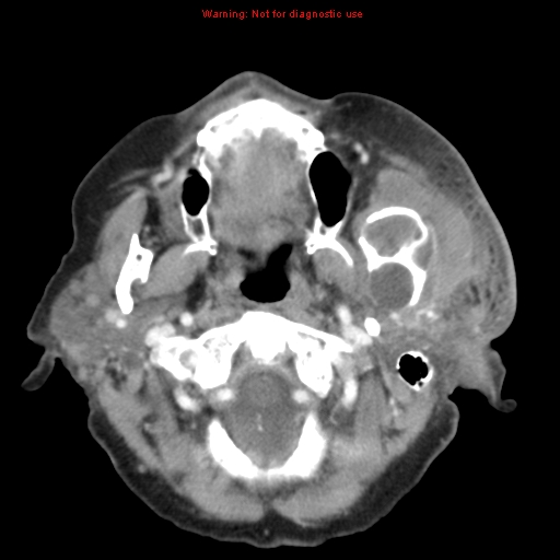 Ameloblastoma (Radiopaedia 27437-27631 A 25).jpg