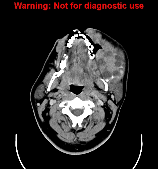 File:Ameloblastoma (Radiopaedia 33126-34164 B 7).jpg