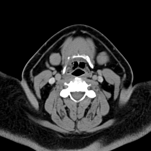 Ameloblastoma (Radiopaedia 38520-40623 Axial non-contrast 43).png