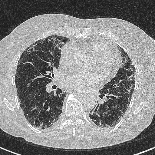 Amiodarone-induced pulmonary fibrosis (Radiopaedia 82355-96460 Axial lung window 39).jpg