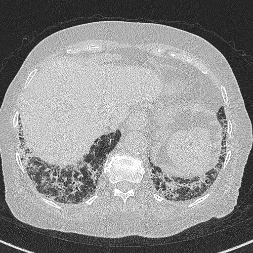 Amiodarone-induced pulmonary fibrosis (Radiopaedia 82355-96460 Axial lung window 58).jpg