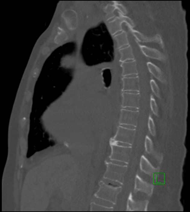 Amiodarone deposition in the liver (Radiopaedia 77587-89780 Sagittal bone window 55).jpg