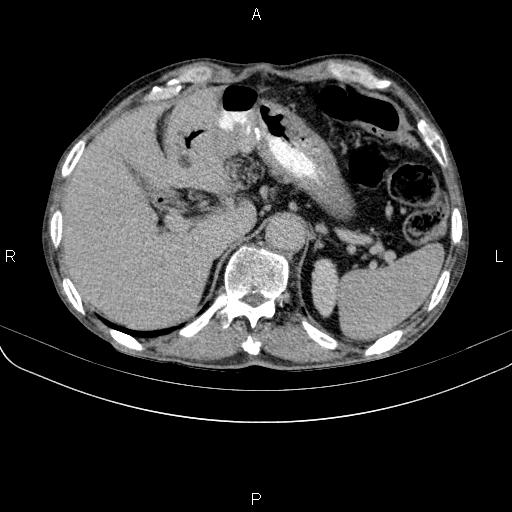 Ampullary adenocarcinoma (Radiopaedia 86093-102033 Axial C+ delayed 27).jpg