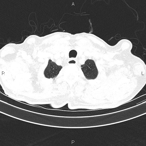 Ampullary adenocarcinoma (Radiopaedia 86093-102033 Axial lung window 14).jpg