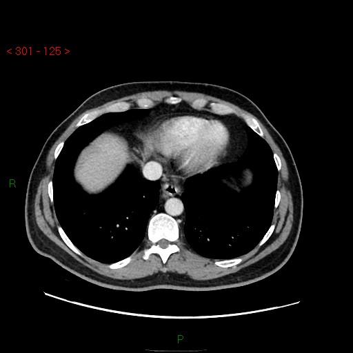 File:Ampullary carcinoma (Radiopaedia 56396-63056 C 11).jpg