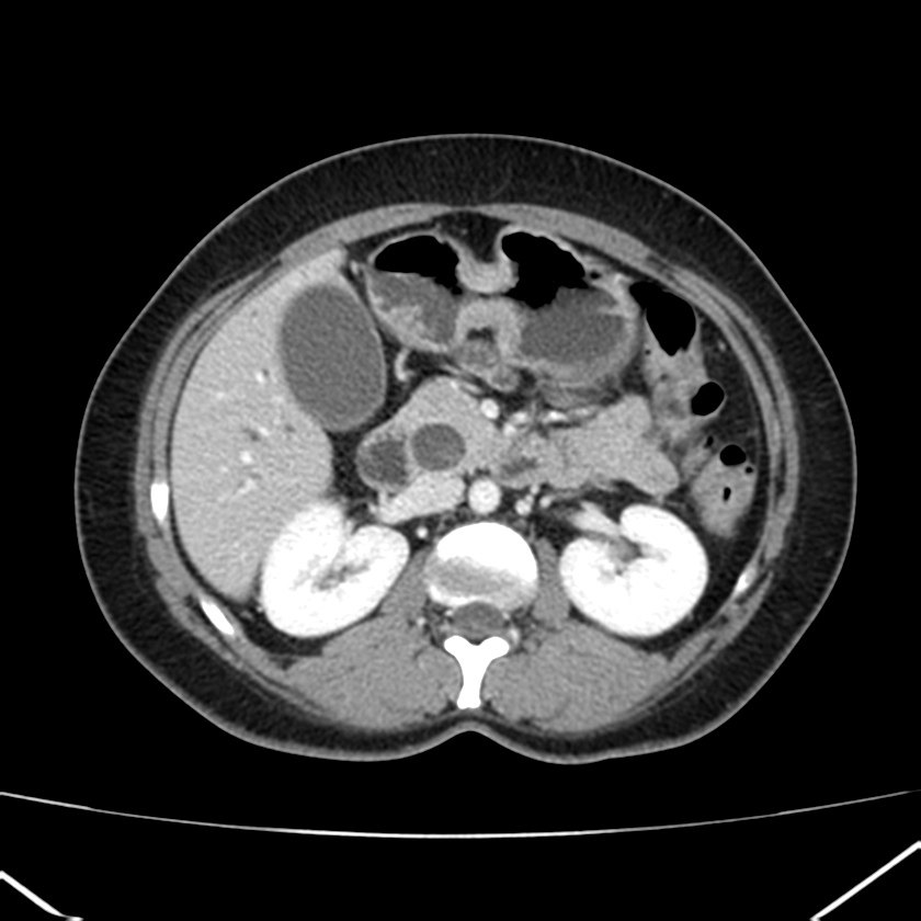 Ampullary tumor (Radiopaedia 22787-22816 C 26).jpg