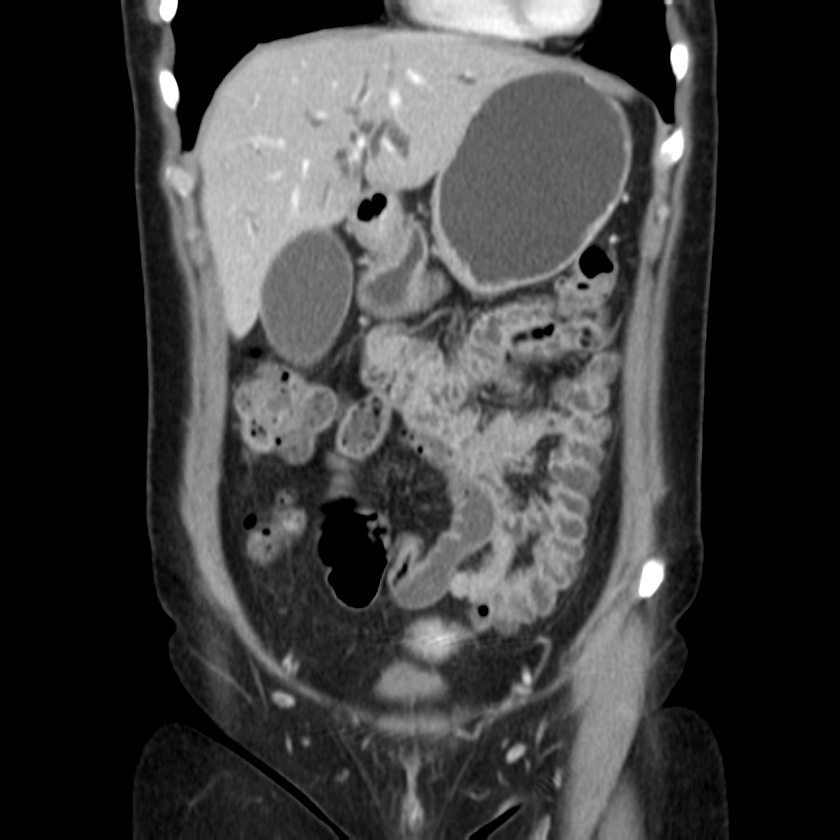 Ampullary tumor (Radiopaedia 22787-22816 E 17).jpg