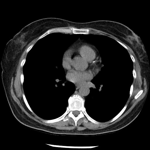 File:Amyloidosis - bronchial and diffuse nodular pulmonary involvement (Radiopaedia 60156-67744 Axial non-contrast 32).jpg
